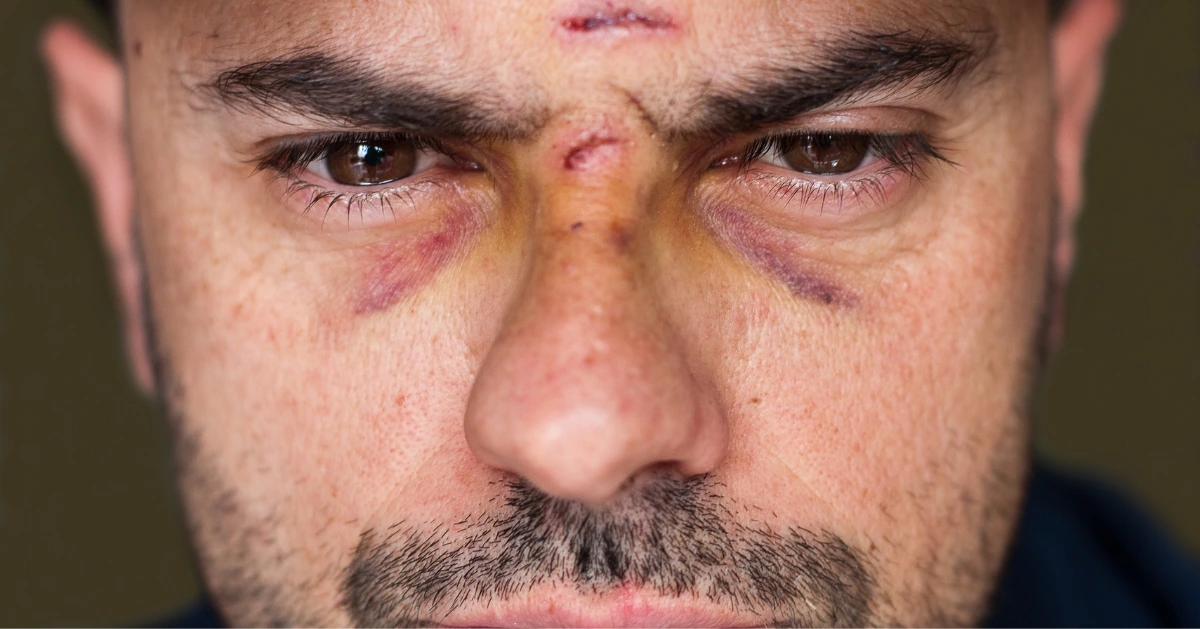 a bruised face