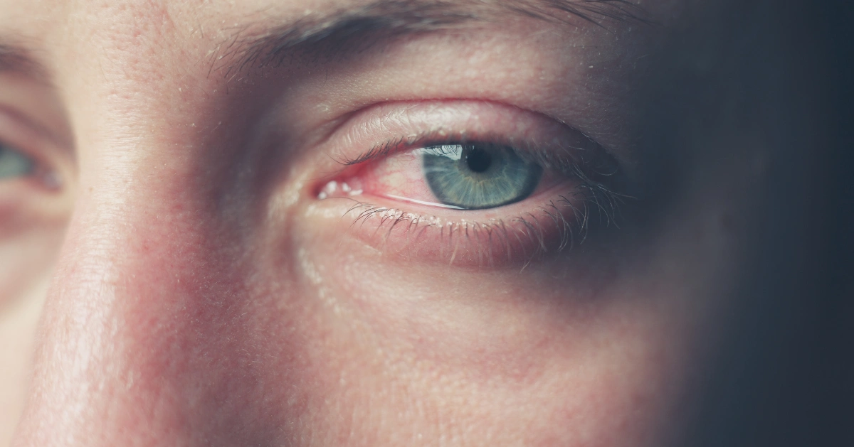 crying eyes